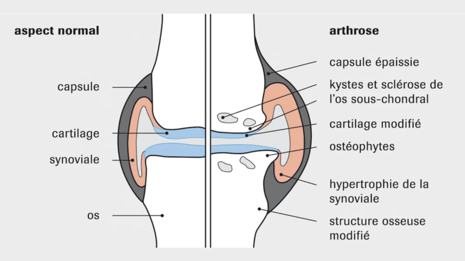 arthrose arthrose