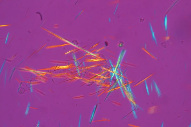 Les cristaux d’acide urique en forme d’aiguilles du liquide synovial, vus sous un microscope à lumière polarisée. © Wikimedia Commons/Bobjgalindo Micrographie de cristaux d'acide urique dans le liquide synovial