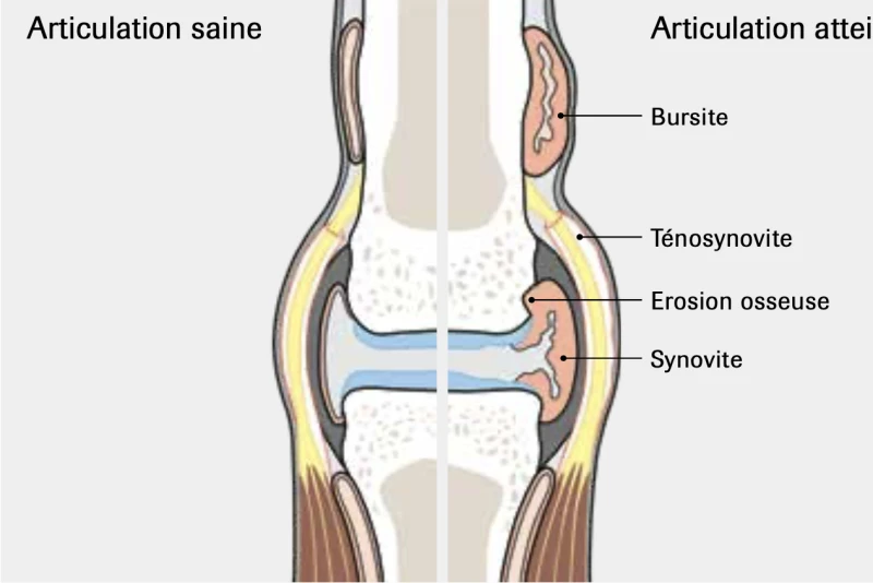 Illustration d'une articulation