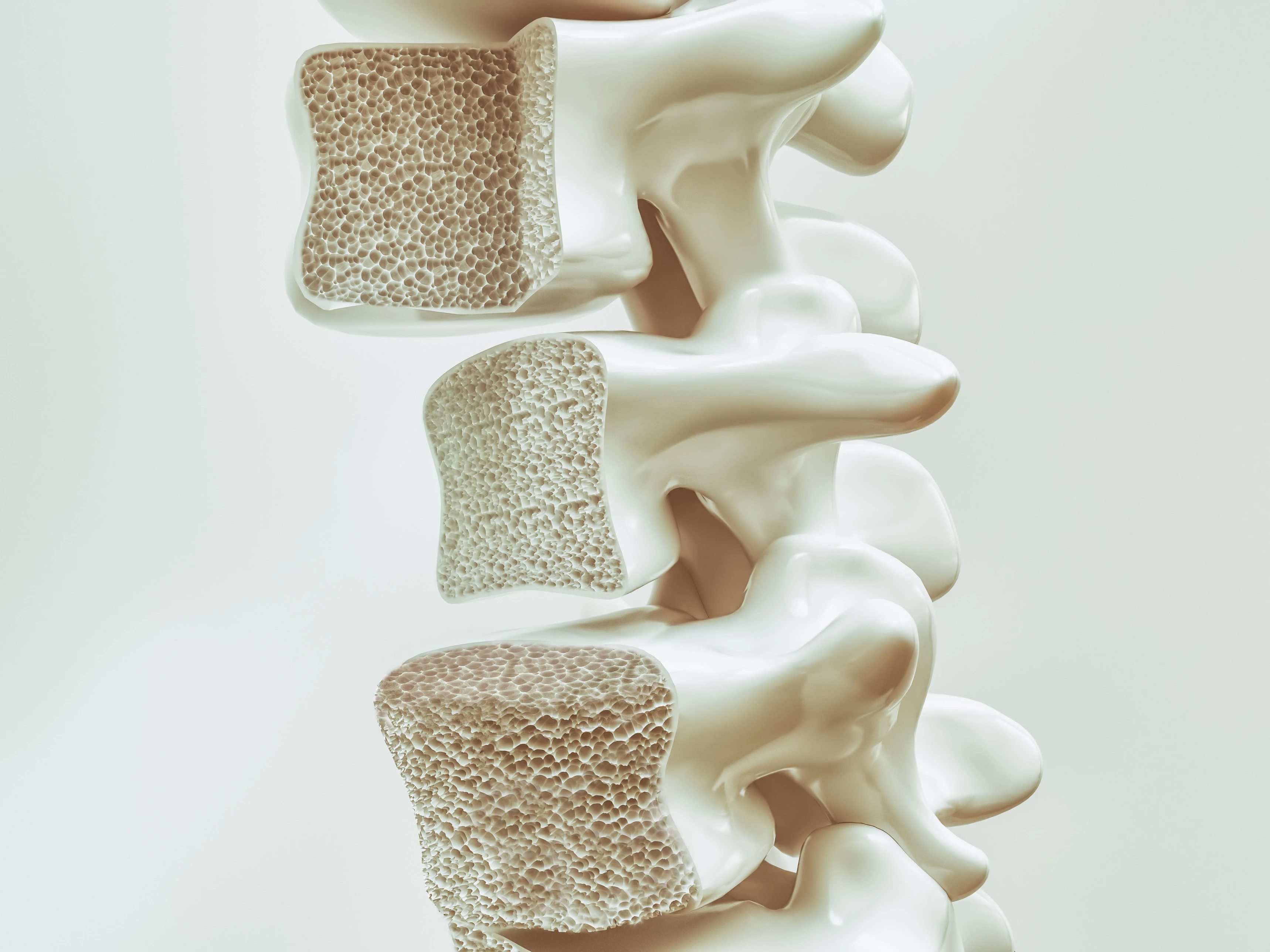 Osteoporose Wirbelsäule Osteoporose Wirbelsäule